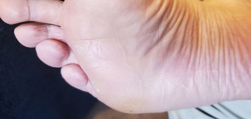 Anti-fungal Peeling Foot Soak photo review