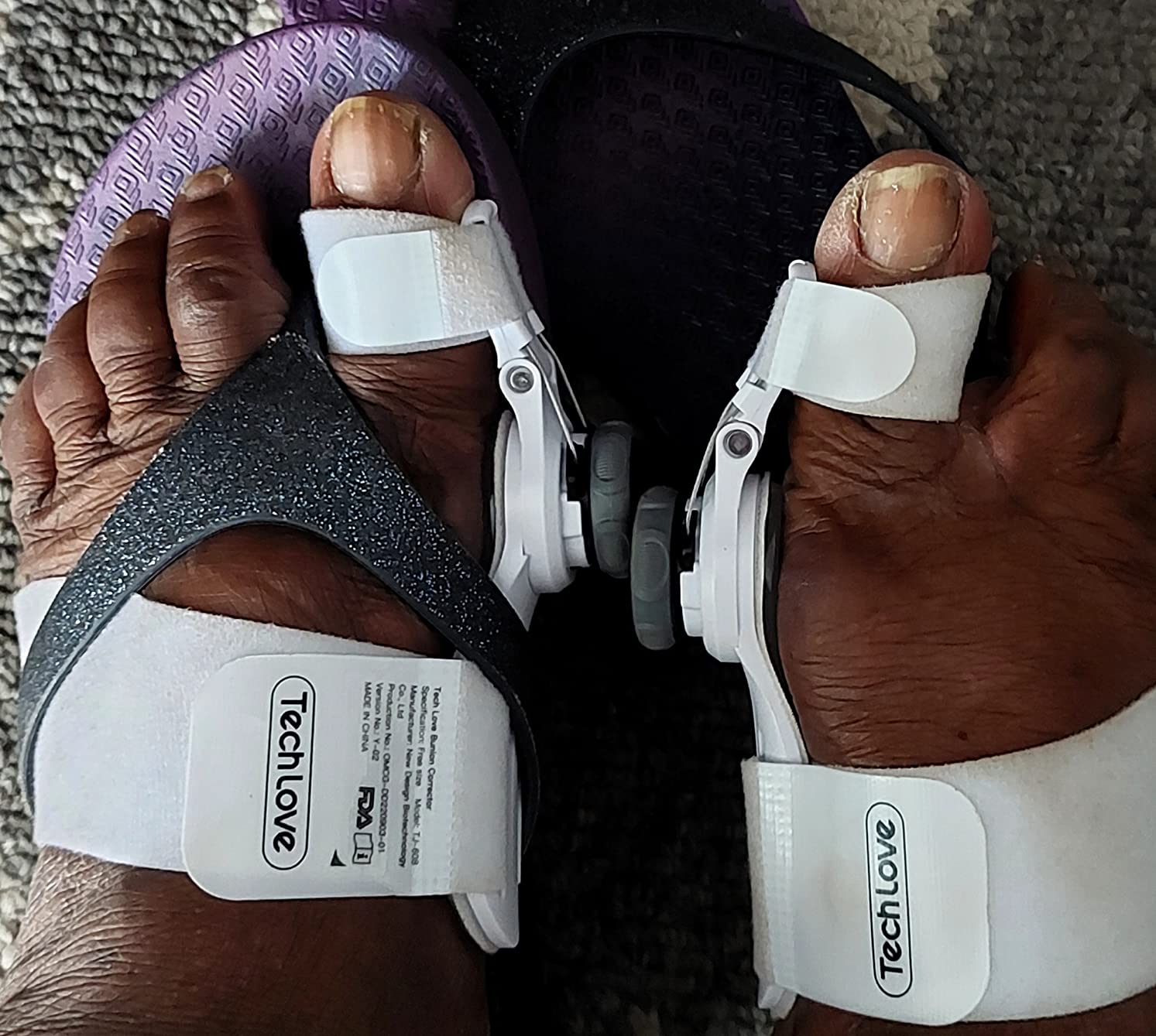 Bunion Splint Big Toe Corrector photo review