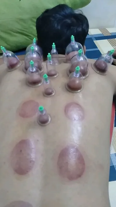 Cupping Therapy Set photo review