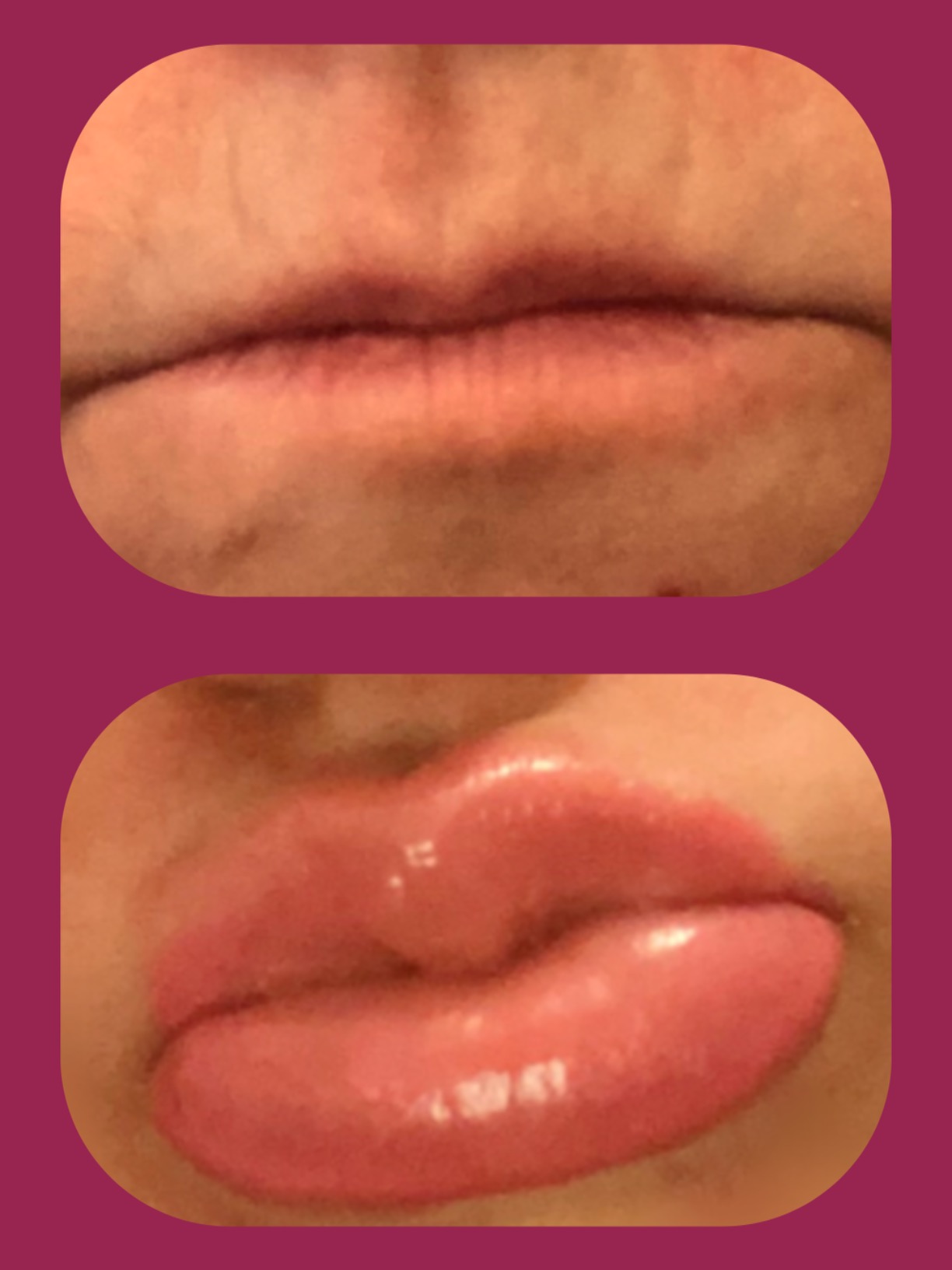 Electric Lip Plumper Device: Get Fuller Lips Naturally photo review