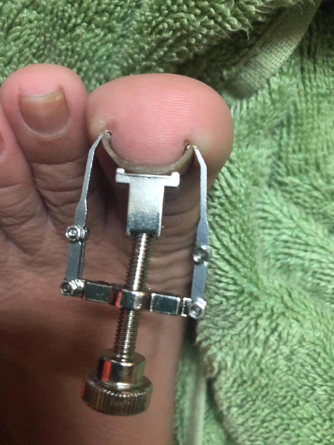 Ingrown Toenail Removal Without Pain photo review